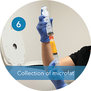 Step 6 Collection of Microfat